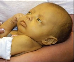 Newborn in parent's arms with jaundice, yellowish skin.